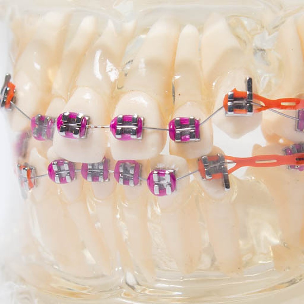 Brackets Roth 022 Metal Prescurved Orc - Imagen 4
