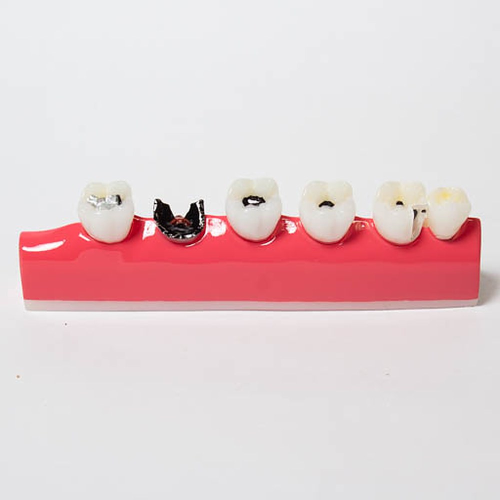 Modelo De Caries Dental - Imagen 2