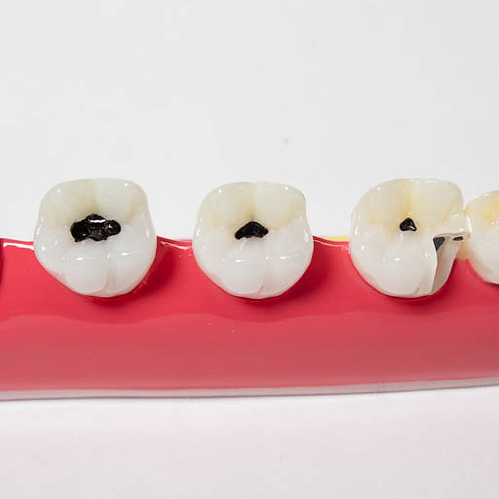 Modelo De Caries Dental - Imagen 3