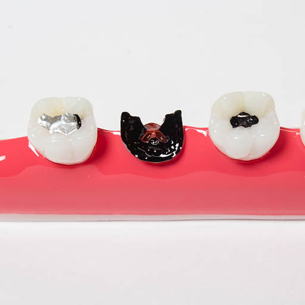 Modelo De Caries Dental - Imagen 4