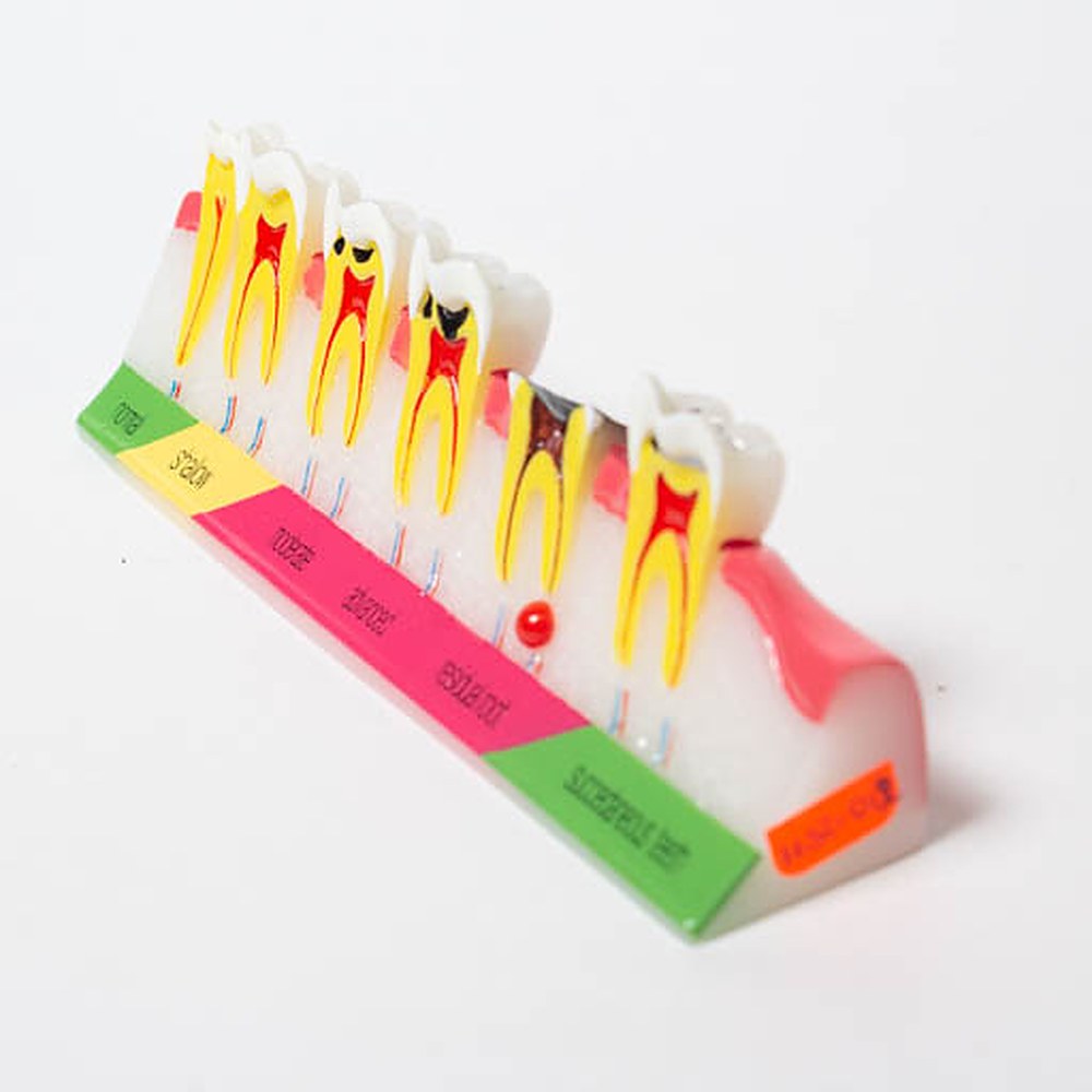 Modelo De Caries Dental
